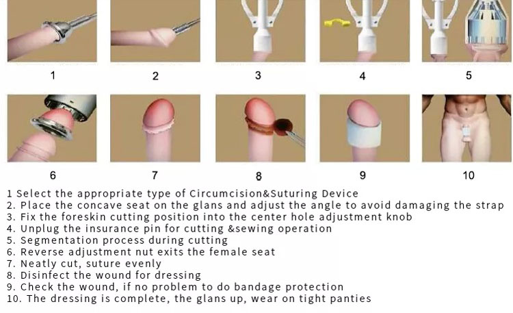 Disposable Circumcision Stapler