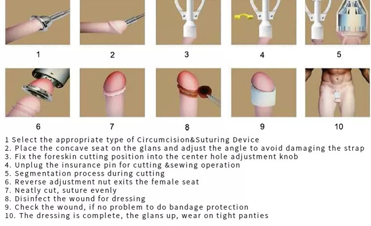 Disposable Circumcision Stapler